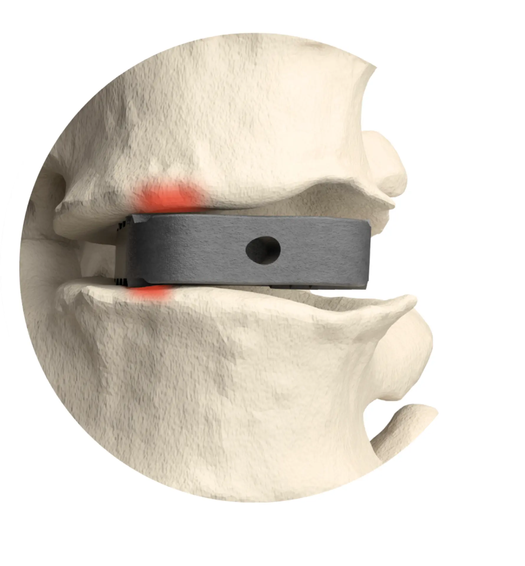 Generic Implant