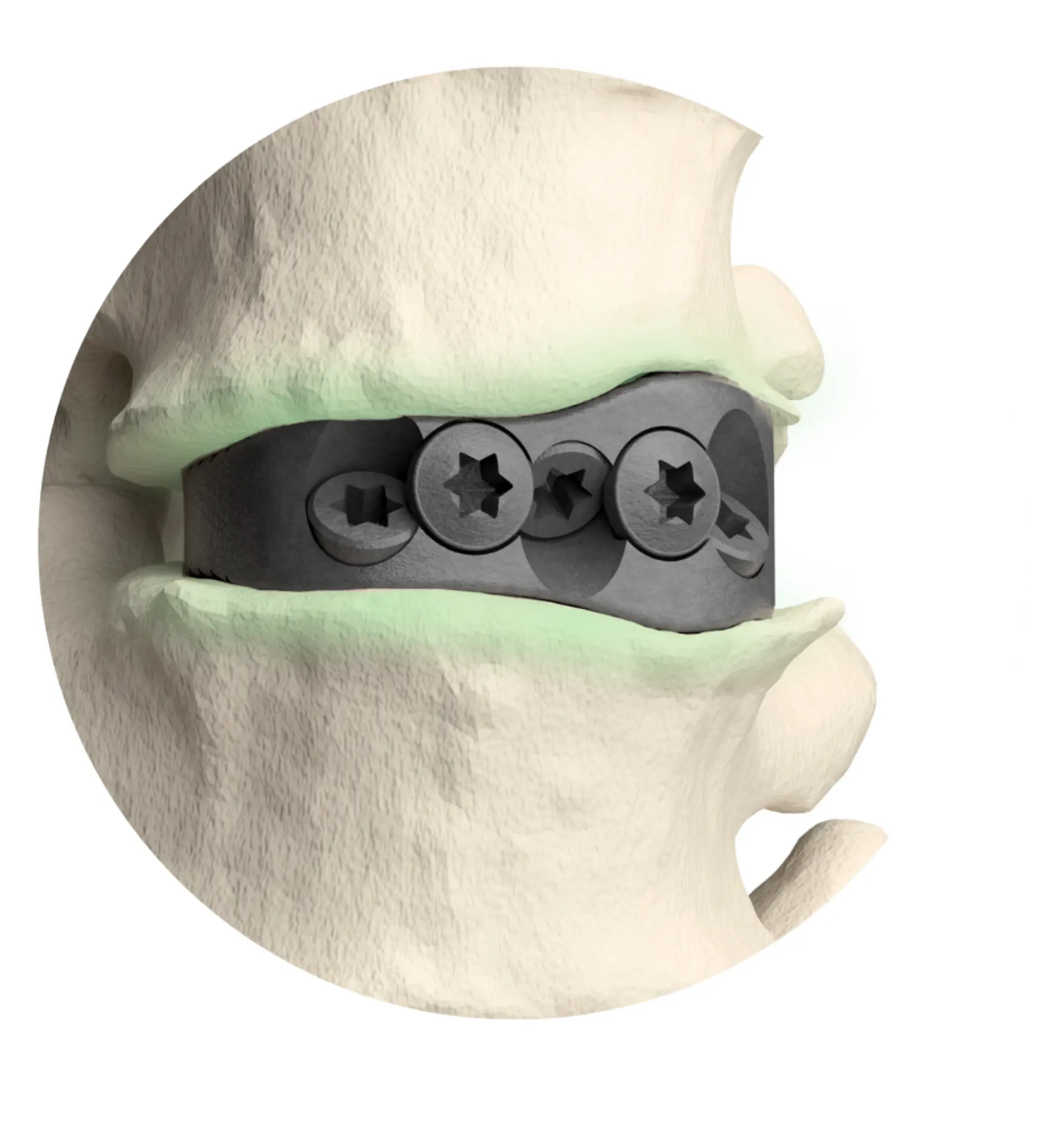 3DMorphic Implant